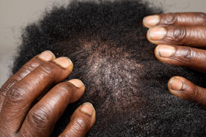 Dark hands on a scalp showing dandruff and dry hair.