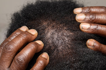 Dark hands on a scalp showing dandruff and dry hair.